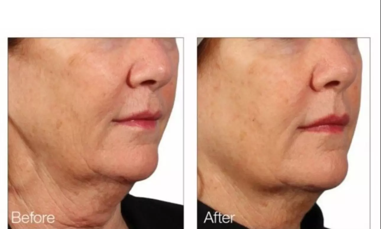Up to 54% Off on Radio Frequency Skin Tightening at Beauty Factory Boutique Spa