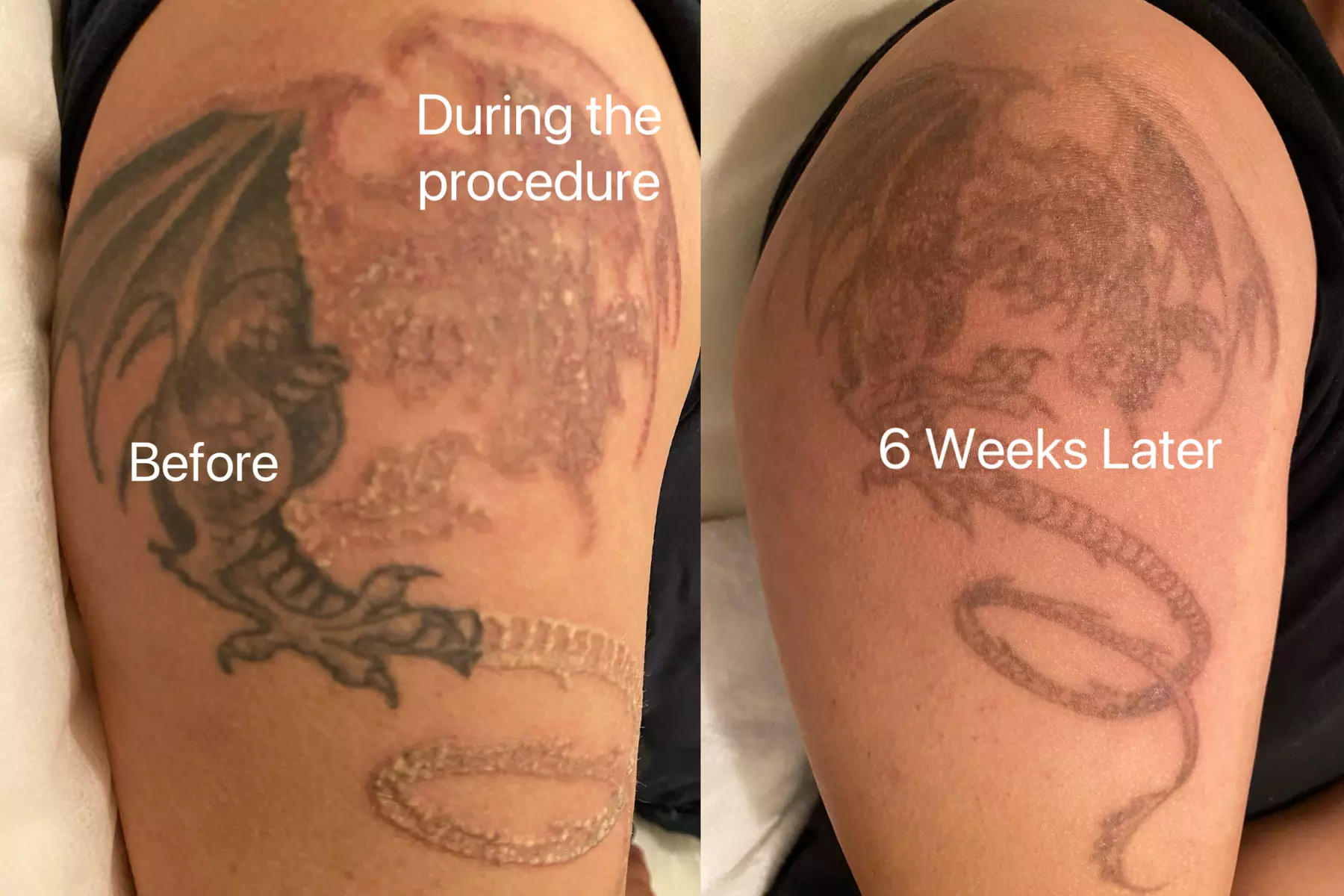 Up to 67% Off on Tattoo Removal at SkinVital Studio