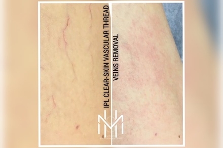 One Small area (2''x1'') - IPL-RF CLEAR SKIN Spider Veins Removal