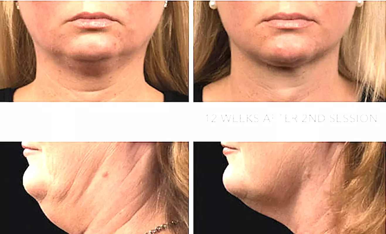 Up to 54% Off on Facial at TRINITYFSA Wellness Beauty Cafe