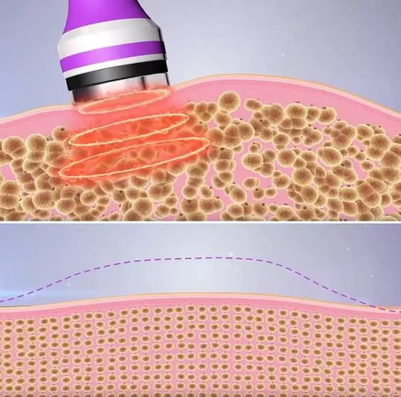 Ultrasonic body sculpting sessions for a toned appearance