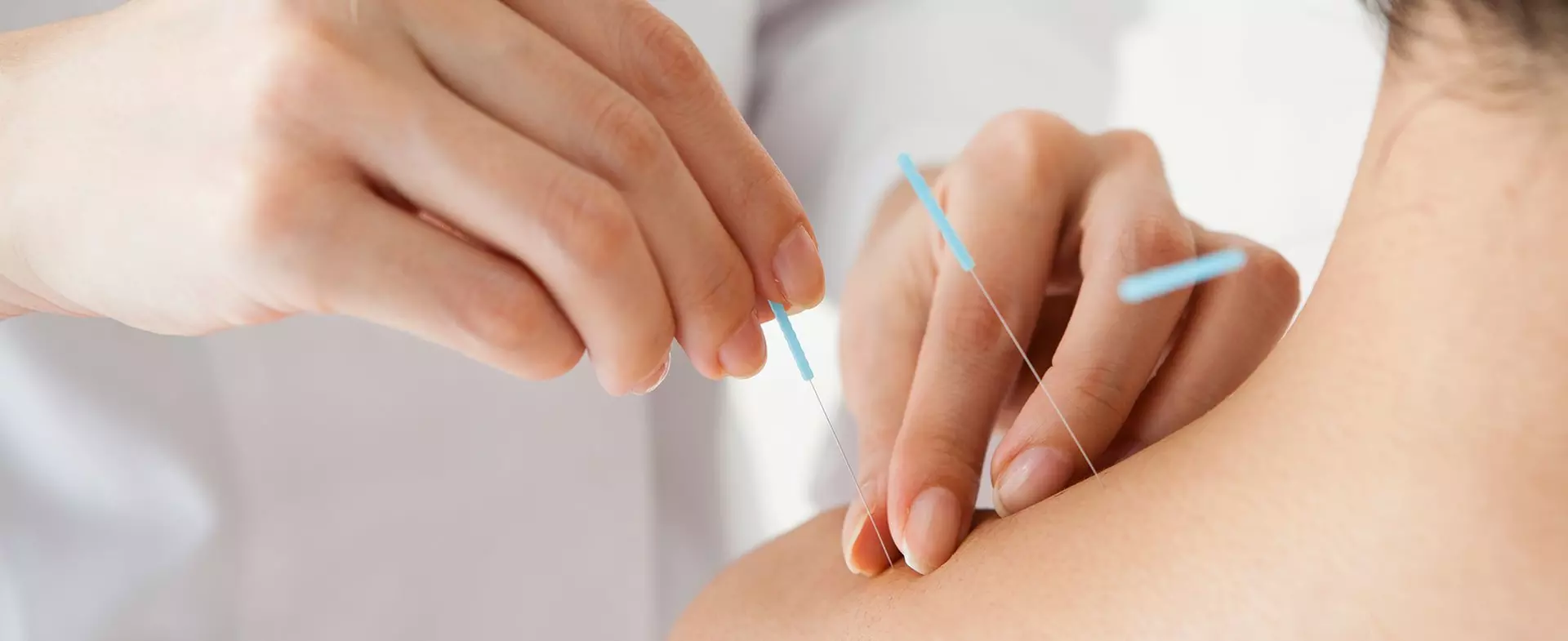 Revitalize your Well-being Through 40-Minute Acupuncture with Consultation (Up To 60% Off) - Primary Image