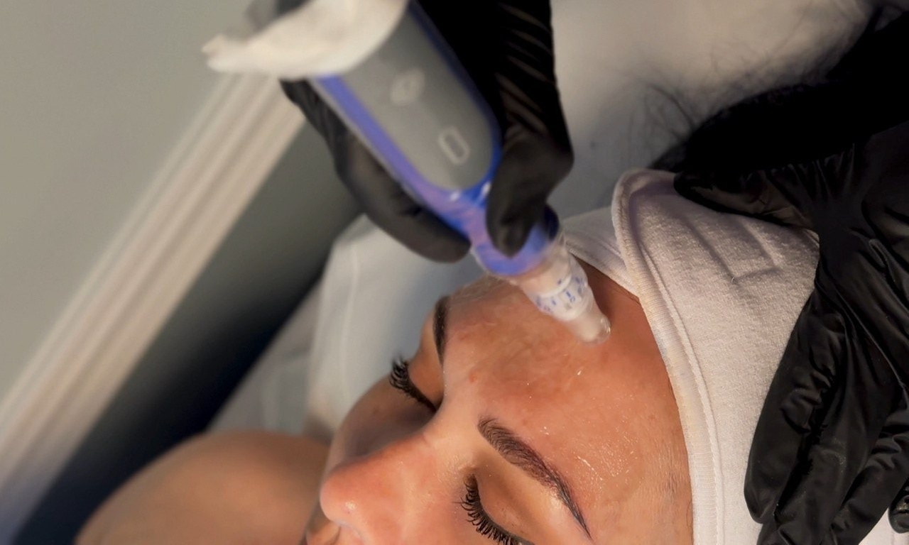 Up to 30% Off on Microneedling at Northshore Health and Beauty