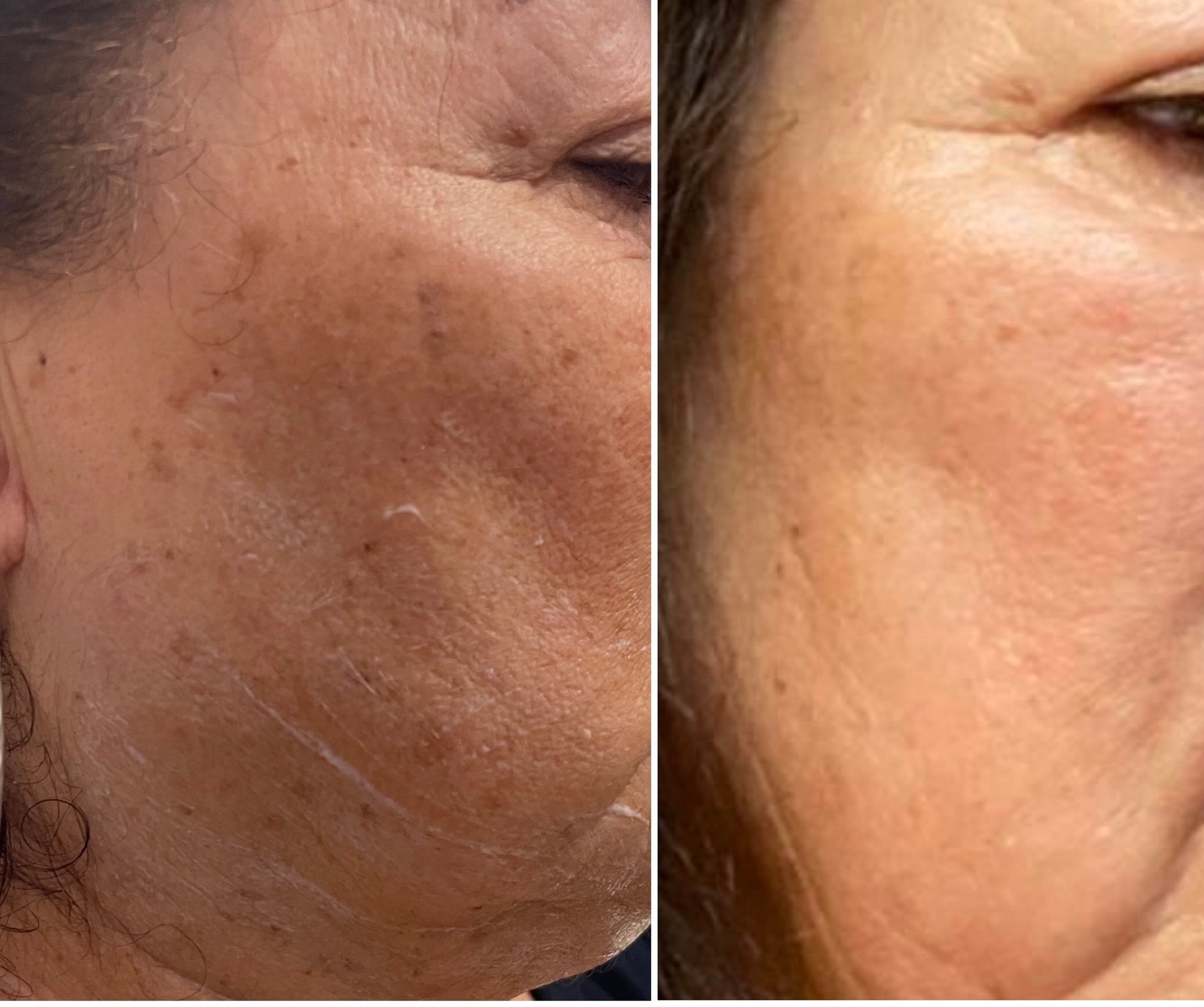 Rejuvenate with Facial Microdermabrasion and HydraFacial Options