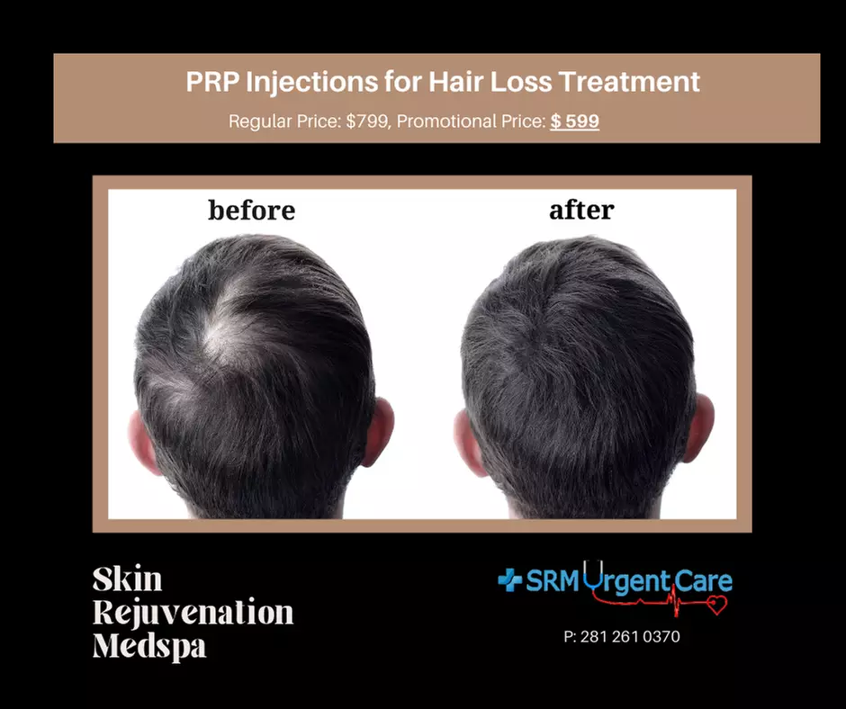 Rejuvenate with PRP Hair Restoration Treatment or Facial Injections