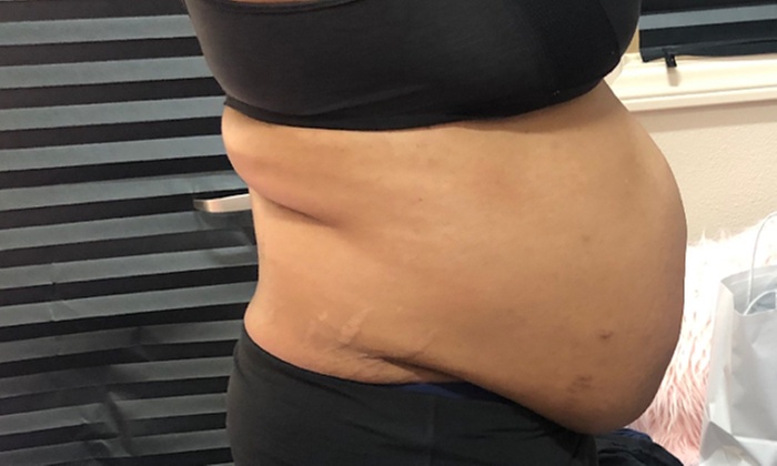 Non-Invasive Body Contouring — Look Good, Feel Good, Do Good!