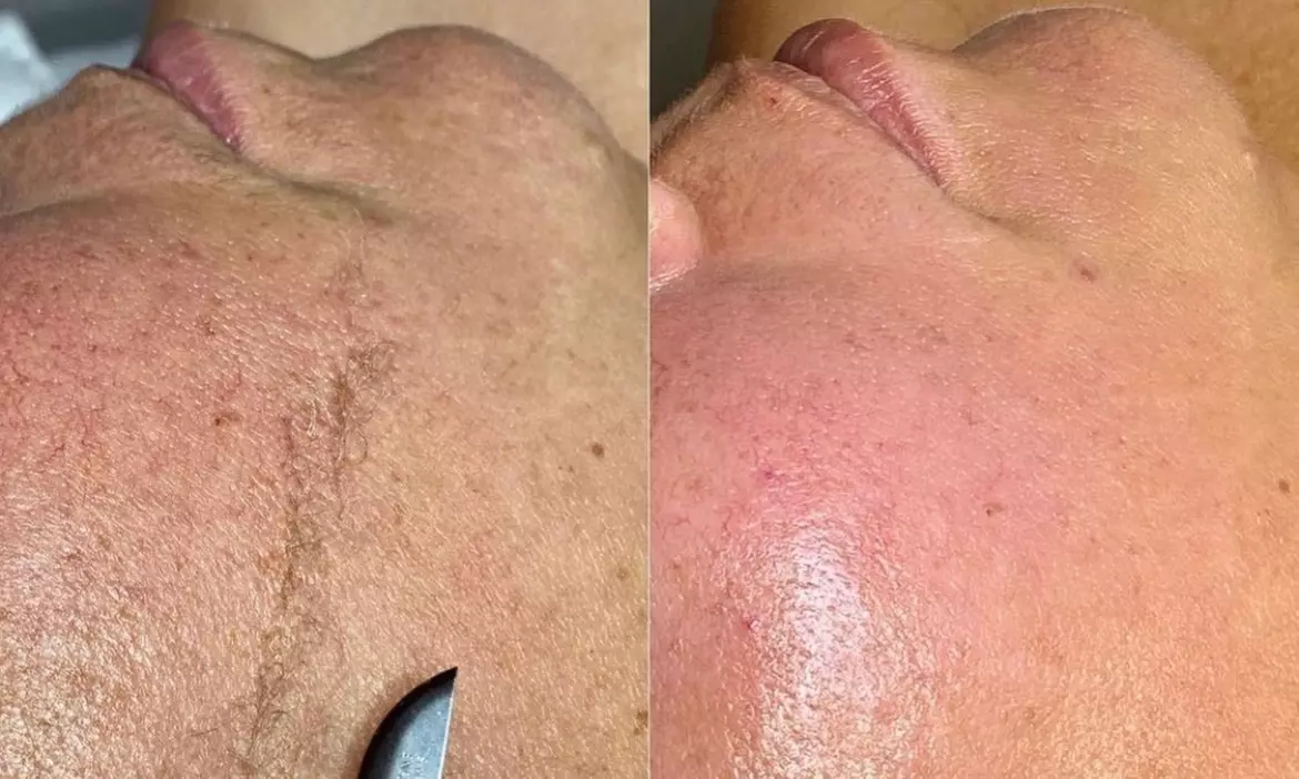 Experience Brittney Love Beauty's range of facials and waxing services with up to 48% off, including dermaplane treatments - Second Medium