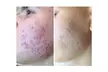 Turn Back Time with the Power of BioRePeel at Rise Skin Spa (Up to 45% Off)
 - Second Medium