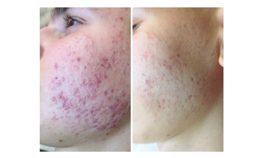 Image 2: Turn Back Time with the Power of BioRePeel at Rise Skin Spa