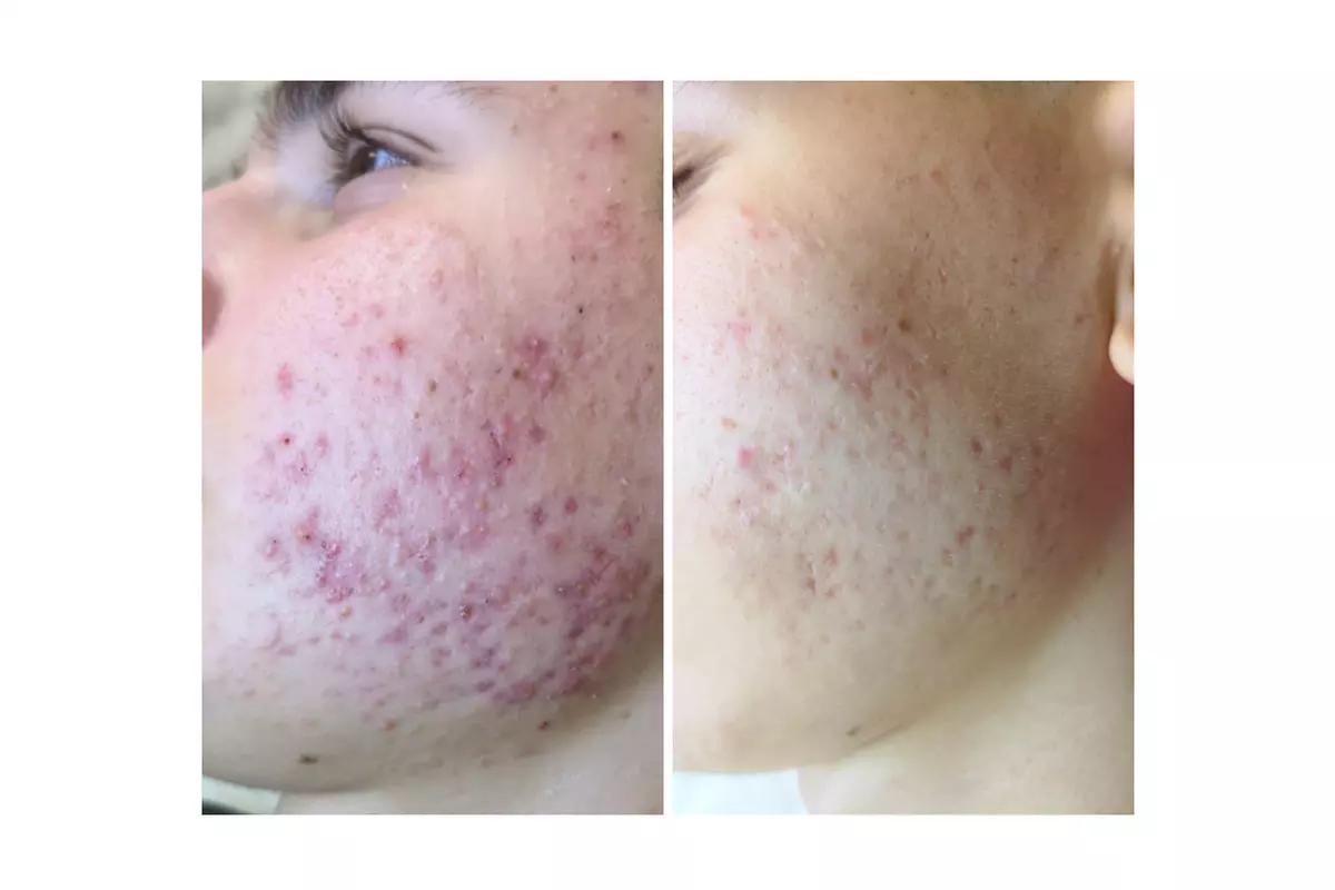 Turn Back Time with the Power of BioRePeel at Rise Skin Spa
