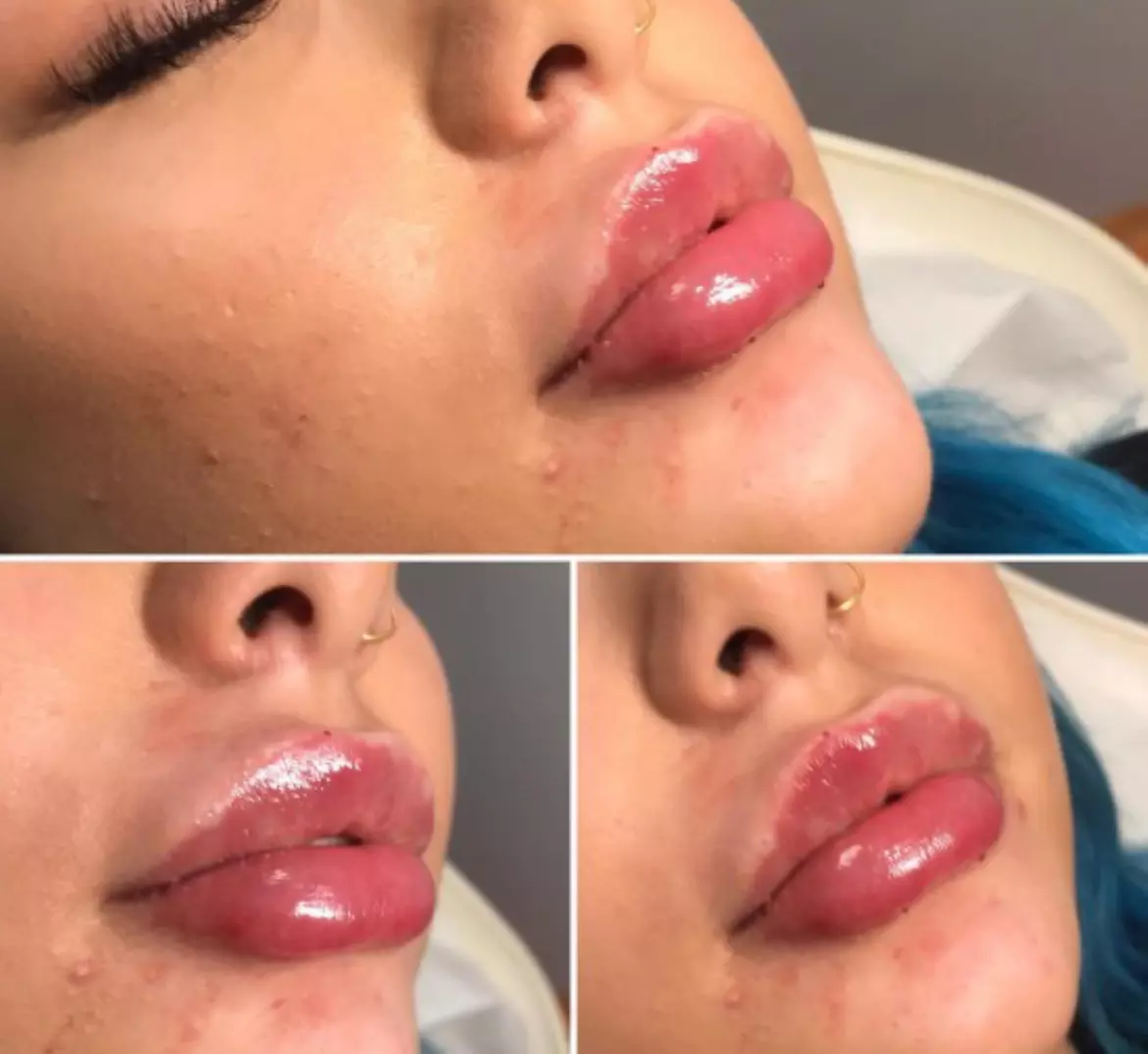 Up to 72% Off on Injection - Dermal Filler at Vanity Box