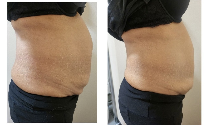 Image 5: One or Two Lymphatic Drainage with Cavitation and RF