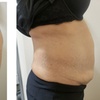 Image 5: One or Two Lymphatic Drainage with Cavitation and RF