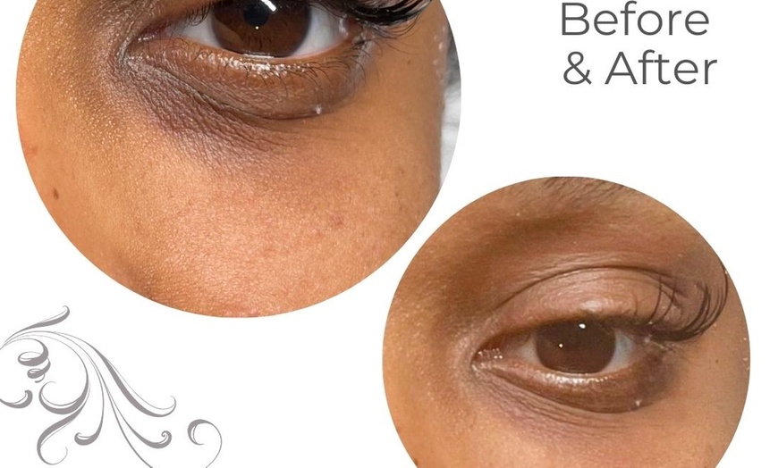 Image 2: Dark Circle / Under Eye Treatment at Shani Aesthetics