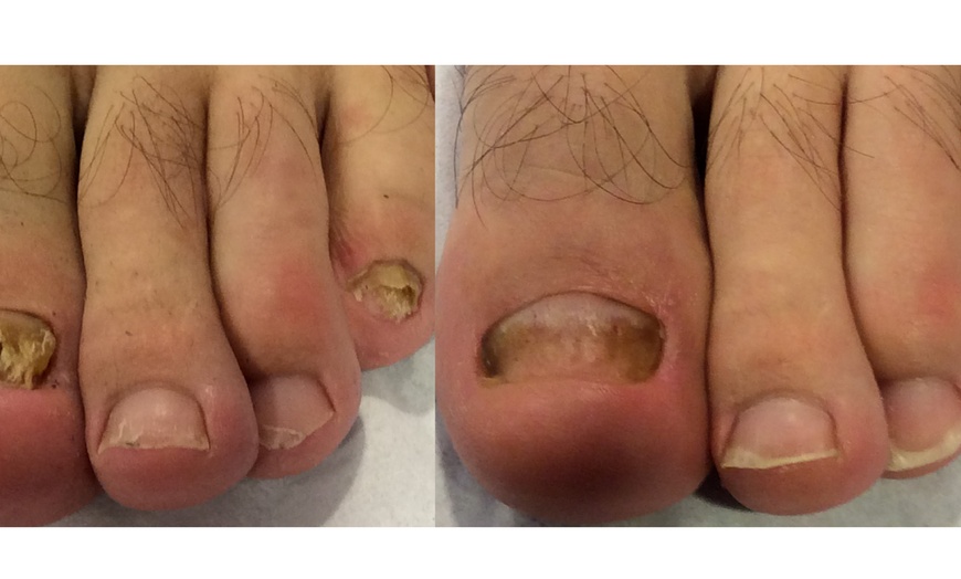 Image 2: Expert Podiatry Consultation for Fungal Toenail Relief @ Raymond Nash