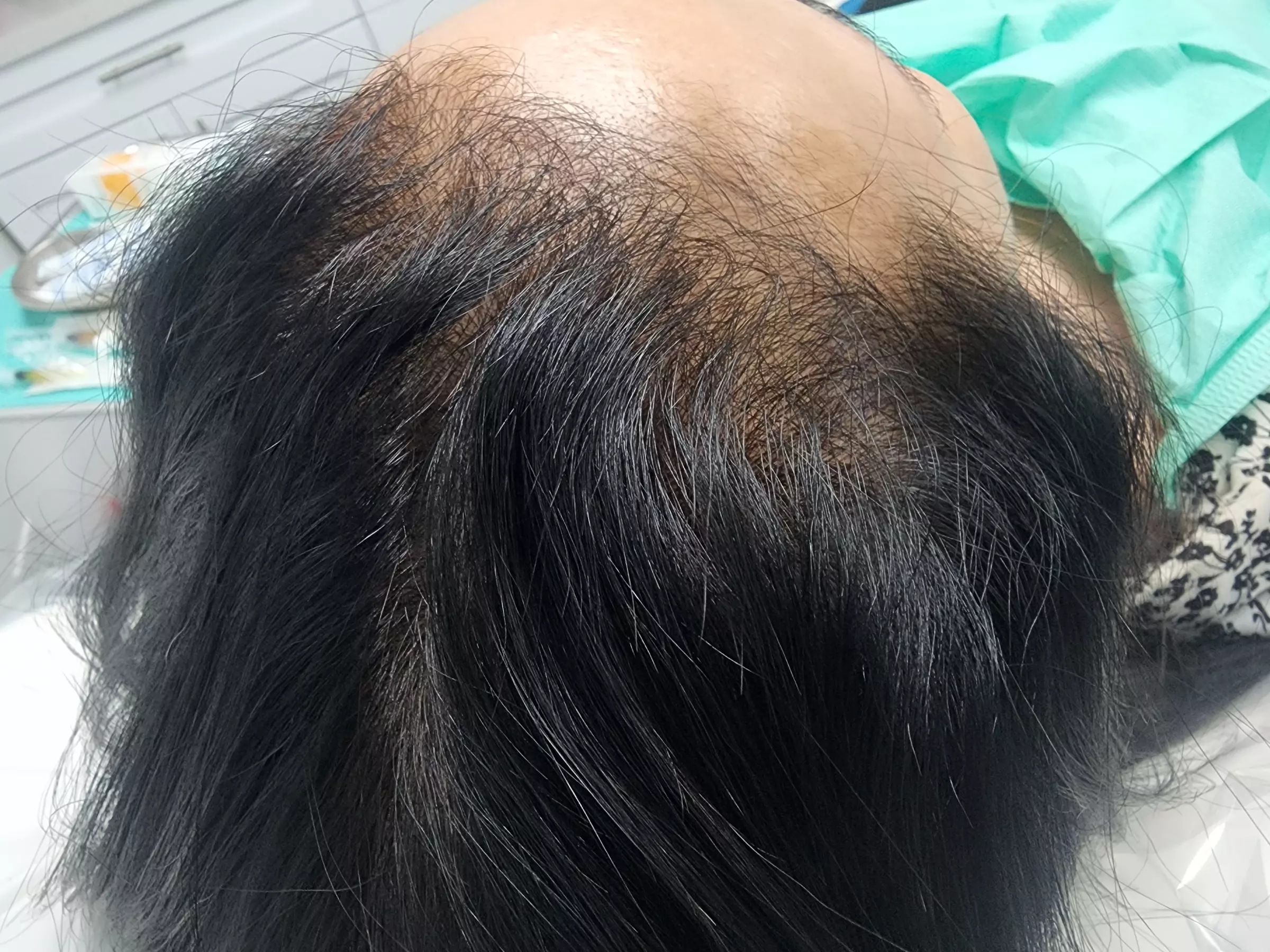 Boost Hair Growth with PRP Hair Restoration Treatments