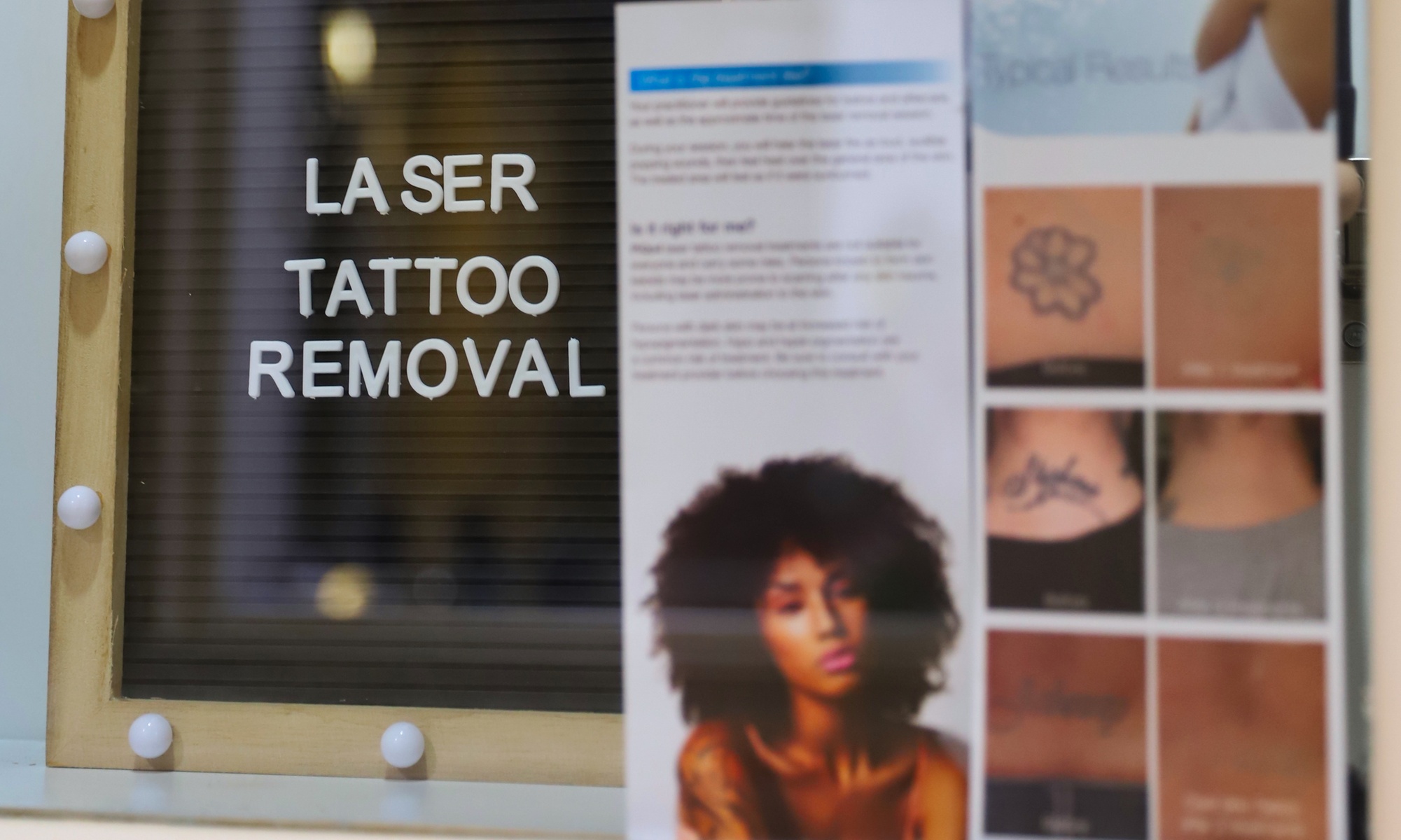 Advanced laser tattoo removal sessions for different sizes