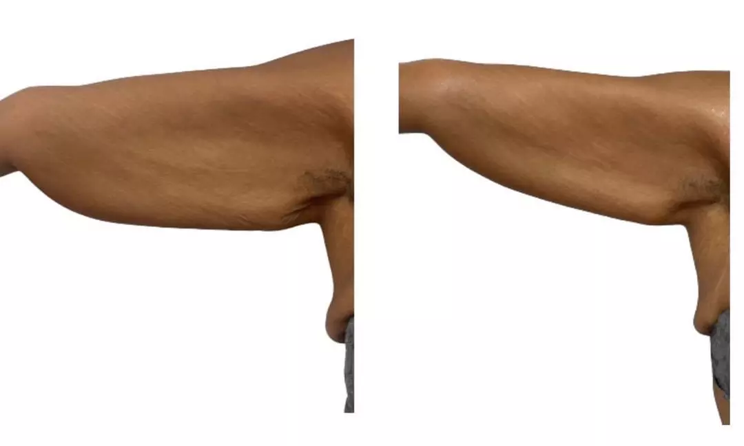 Up to 55% Off on Ultrasonic Fat Reduction