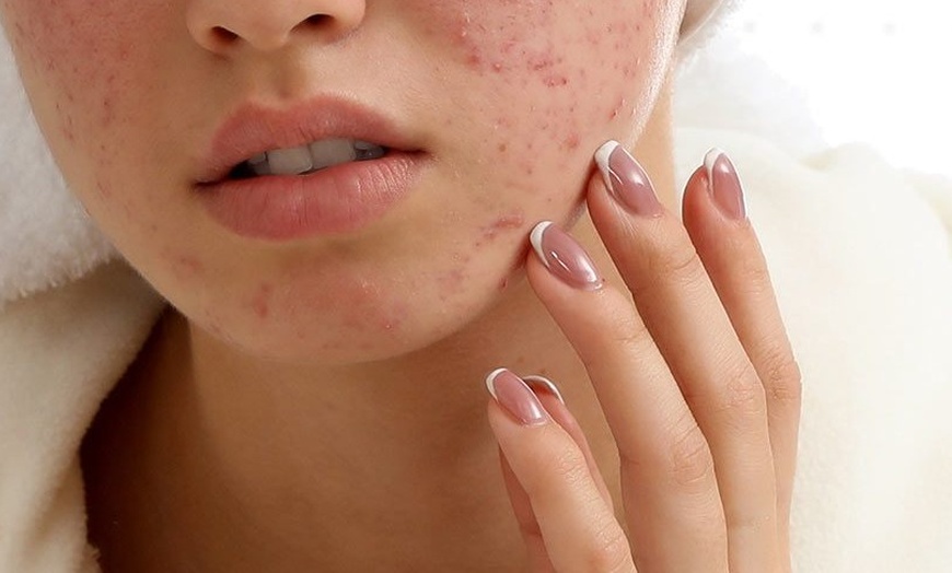 Image 1: Up to 55% Off on Acne Treatment (Service) at UK Aesthetics Lounge