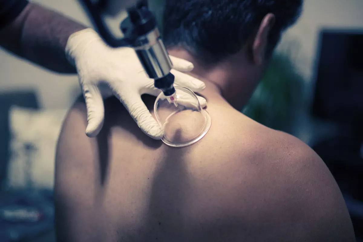 Three Cupping Sessions at Integrated Physical Medicine (Up to 51% Off)