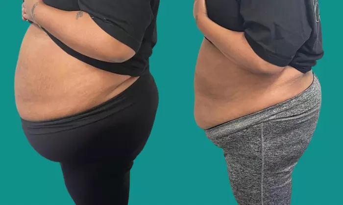 Tay Milz Aesthetics offers a 360 Snatch or Tummy Tuck with up to 49% off for an unmatched body contouring experience. - Primary Image