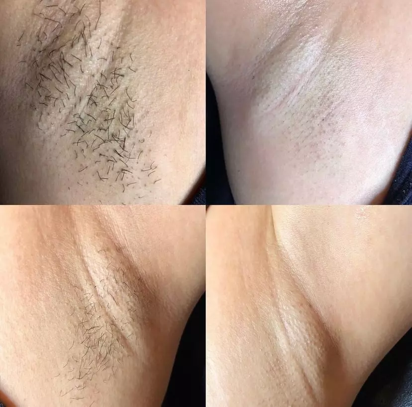 Up to85%Off on Laser Hair Removal at JRNO Wellness Skincare