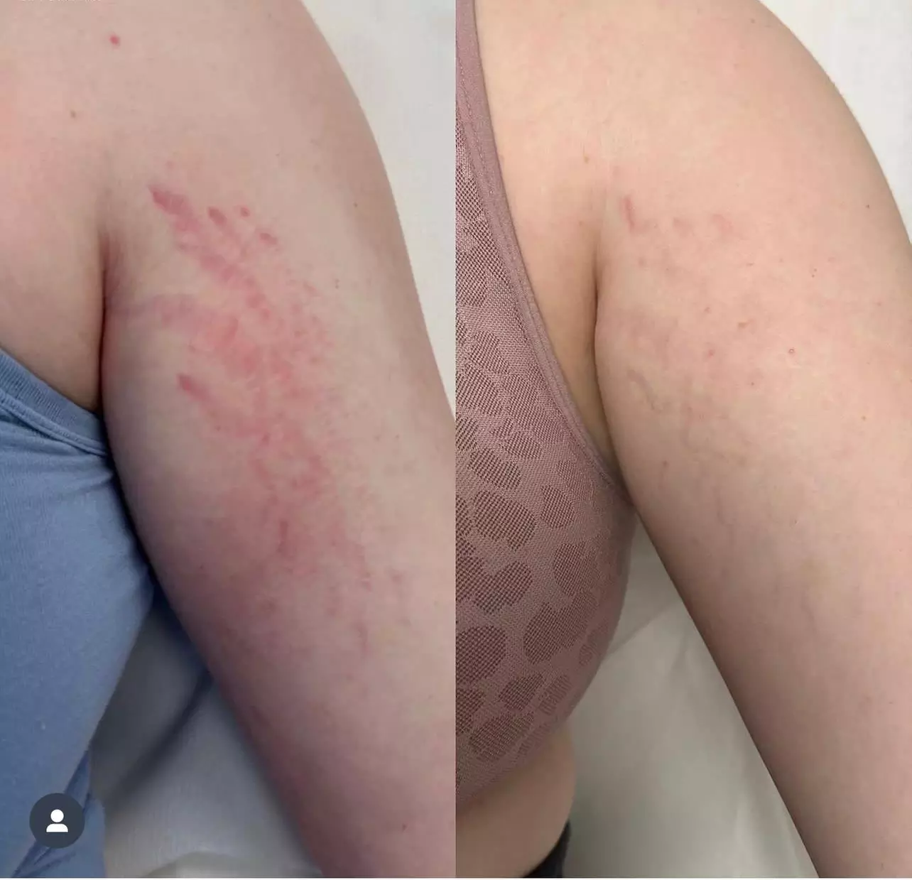 Up to 37% Off on Spider Vein Removal - IPL at Le Belle Aesthetic & Laser - Primary Image
