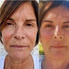 Image 2: Fractional Plasma Resurfacing – Up to 55% Off
