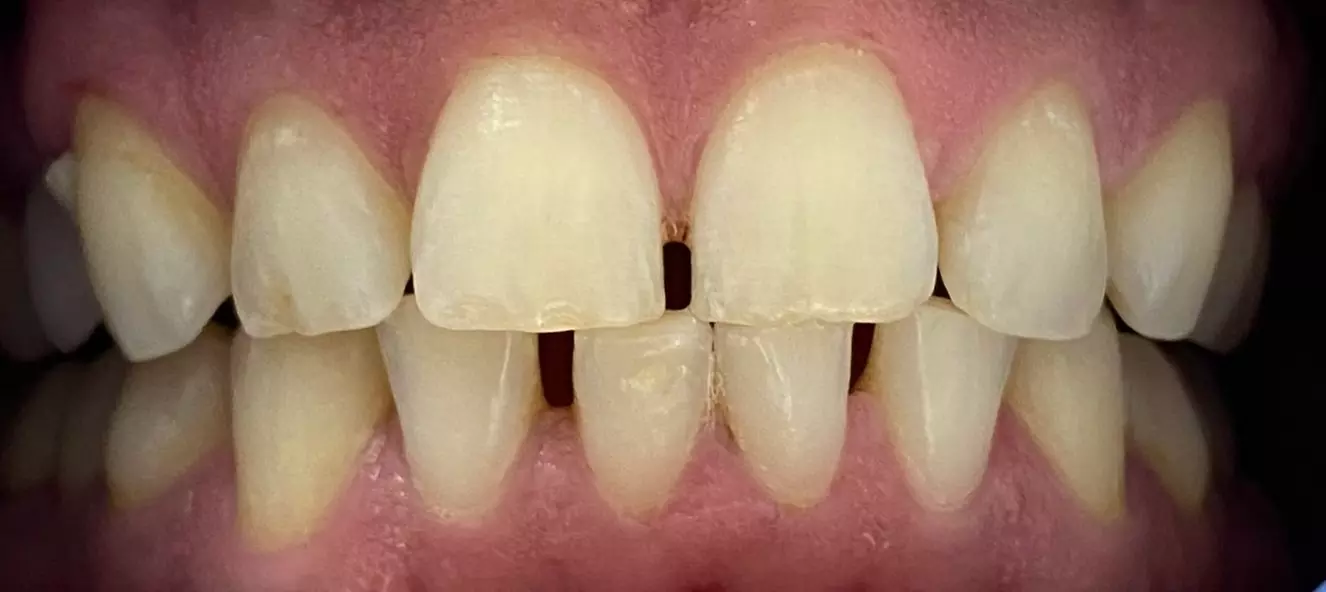 Premier Aesthetics offers organic teeth whitening treatments with options up to 40% off for a brighter smile. - Primary Image