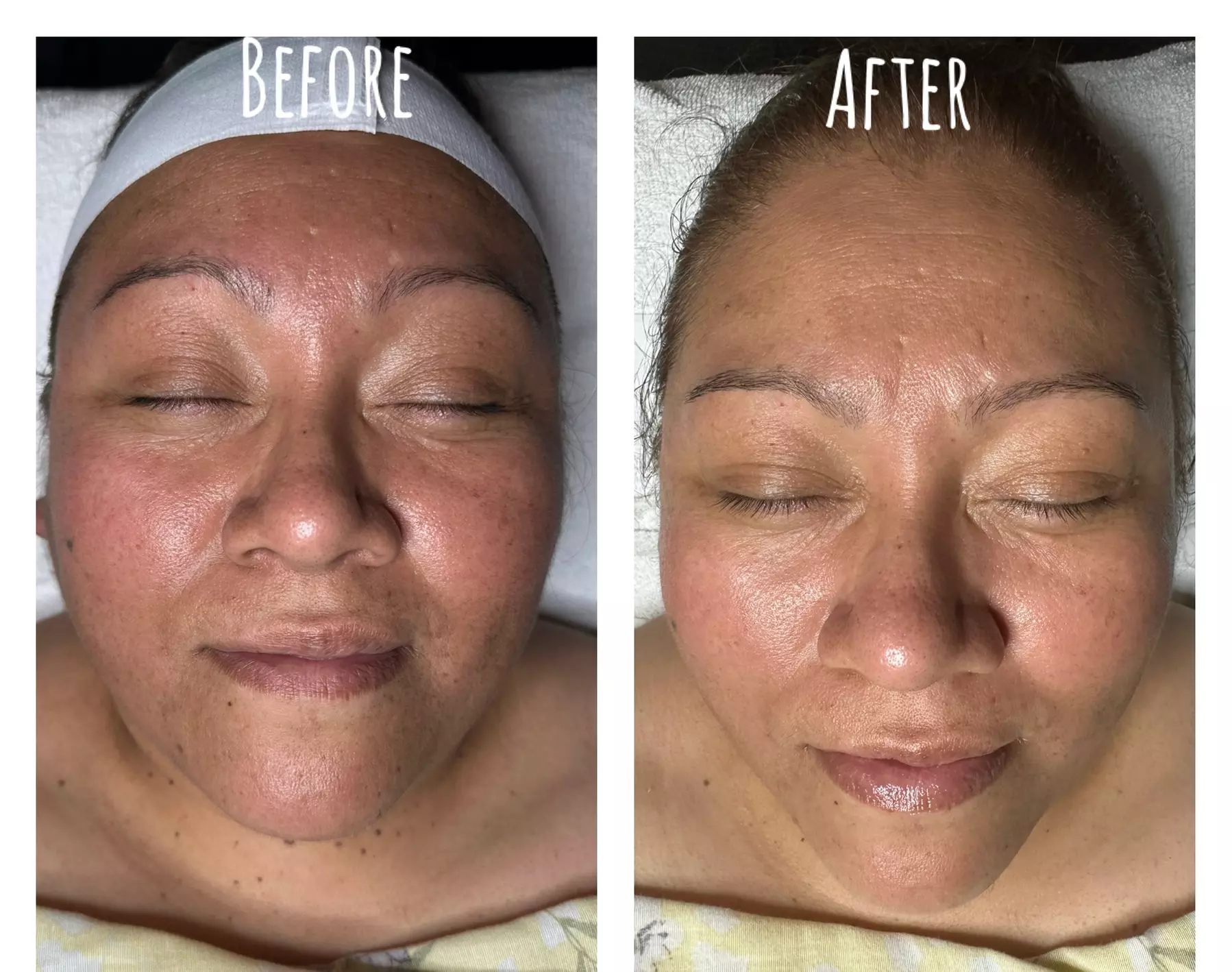 Explore Rejuvenating Facials for Every Skin Type and Need
