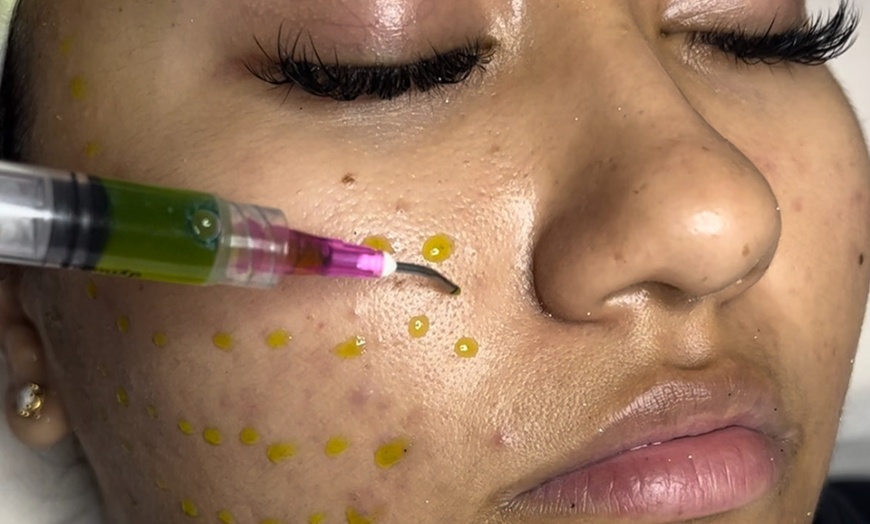 Image 2: Experience a BioRepeel Session with Optional Microdermabrasion Combo