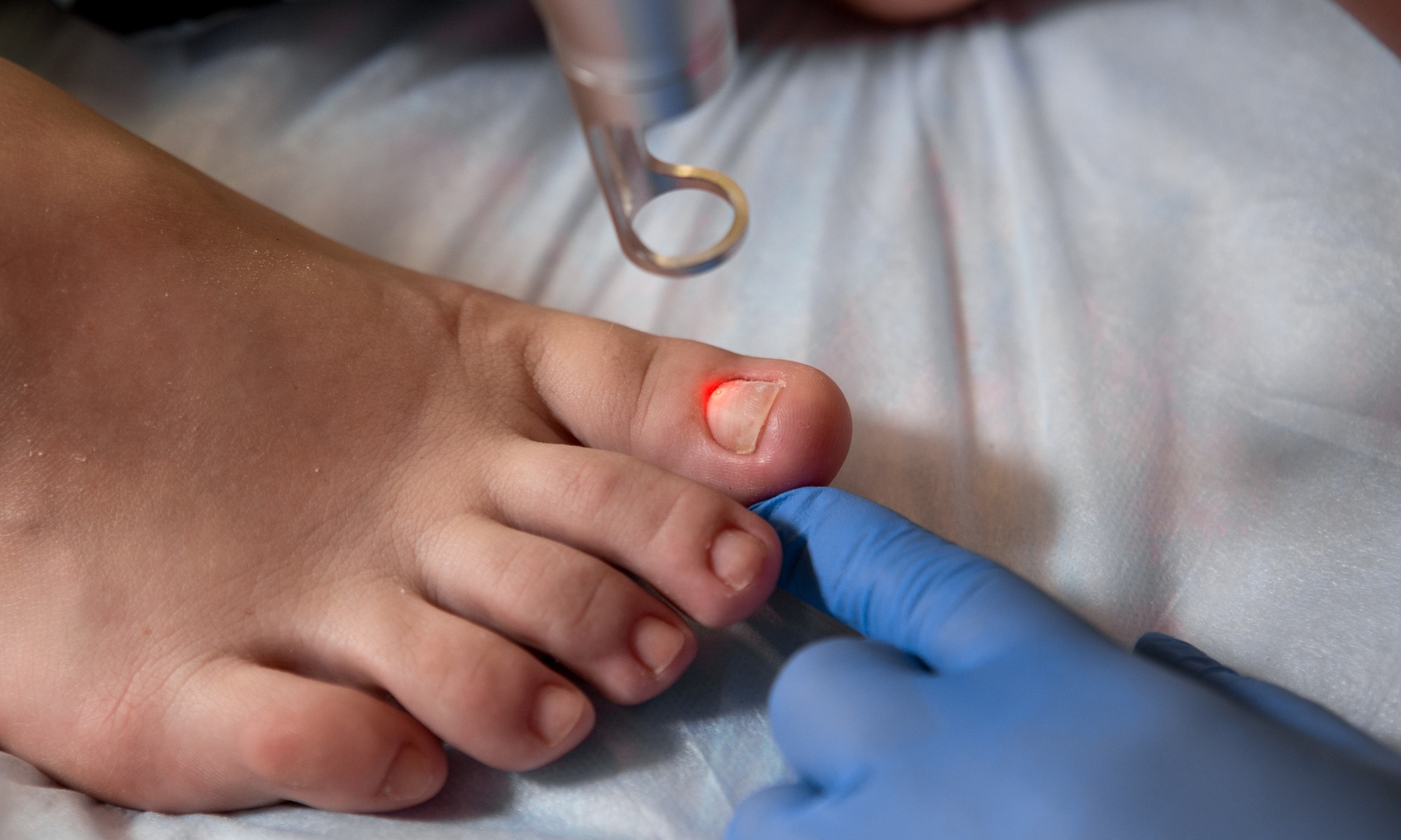Laser Nail-Fungus Removal Sessions for Healthy Feet