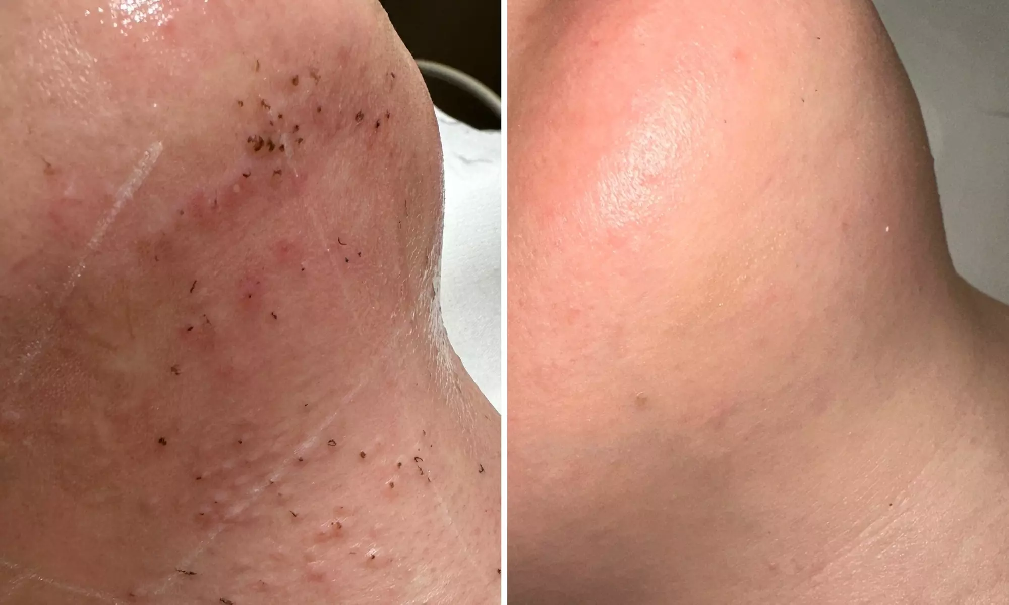 Depilacja laserowa PrimeLase Exellence na wybraną partię ciała