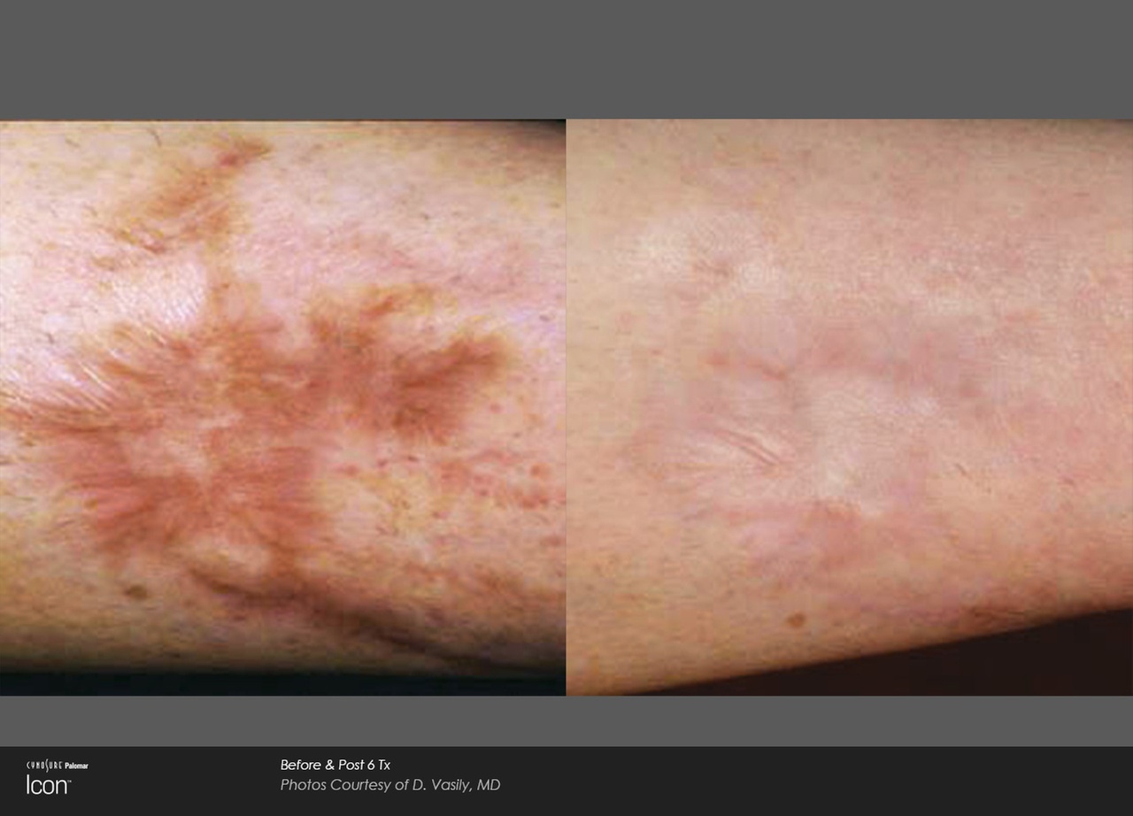 Laser Scar and Stretch Mark Reduction for One Area