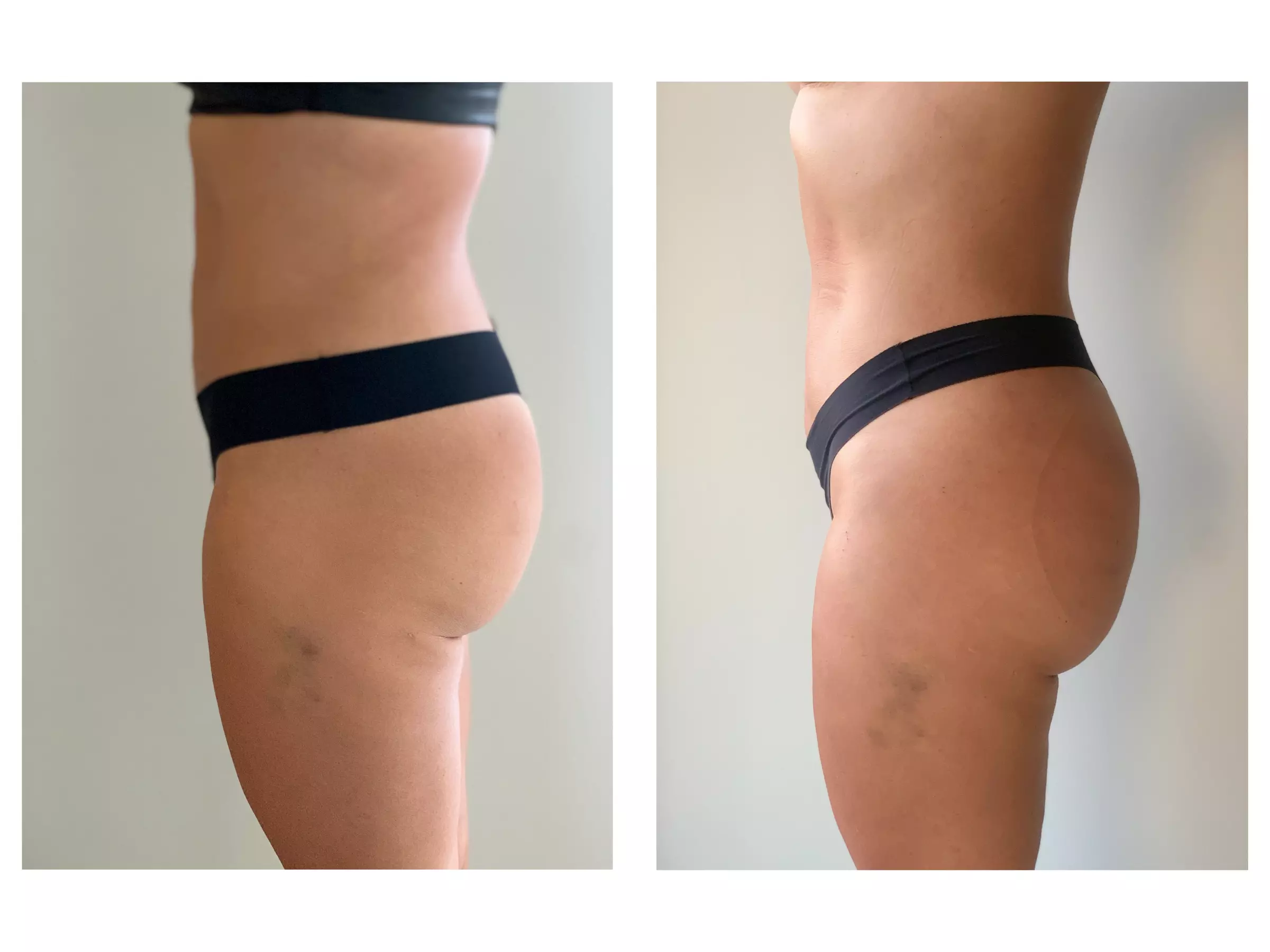 Up to 37% Off on Ultrasonic Fat Reduction at Bodysculpting by Janice - Primary Image