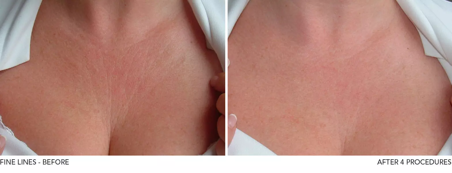 Up to 60% Off on Micro-Needling at Mbar - Primary Image