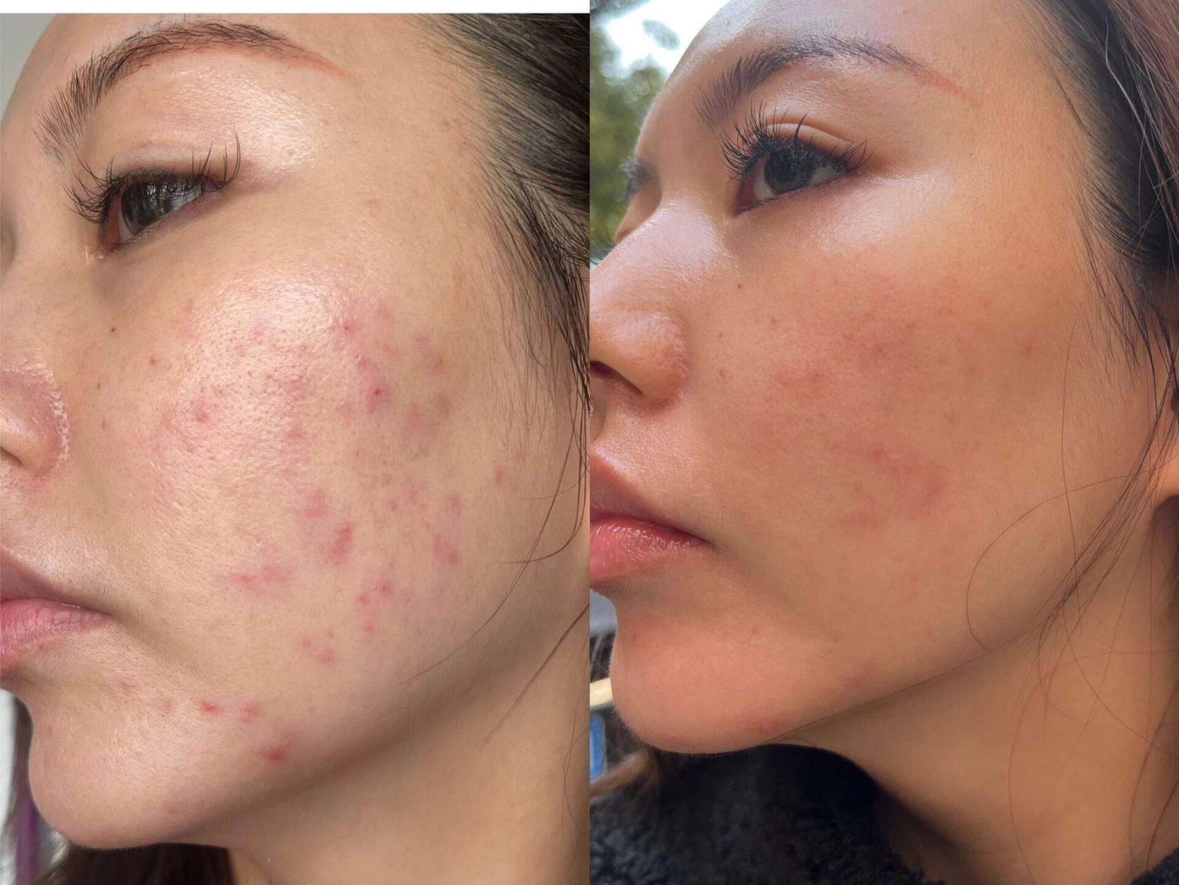 Get smoother skin with one PRP Micro-Needling Session and Consultation