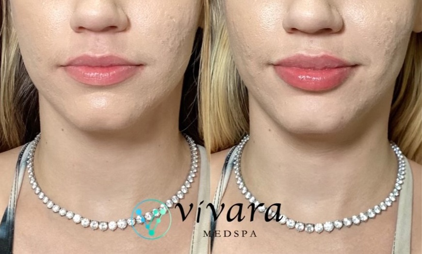 Image 2: 1 Syringe of Juvederm Ultra XC, Vollure, Voluma, Volux or Volbella at Vivara Med Spa(Up to 44% Off)