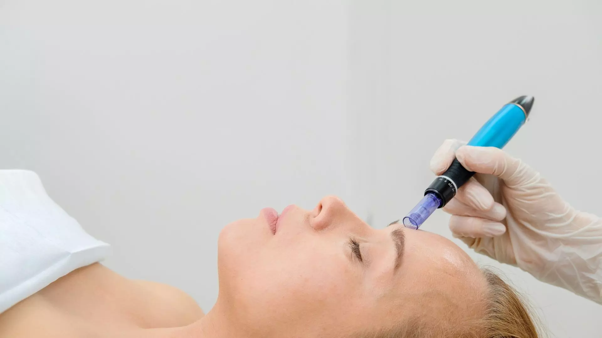 Transform your Skin with Microneedling for a Radiant Complexion (Up to 30% Off) - Second Medium