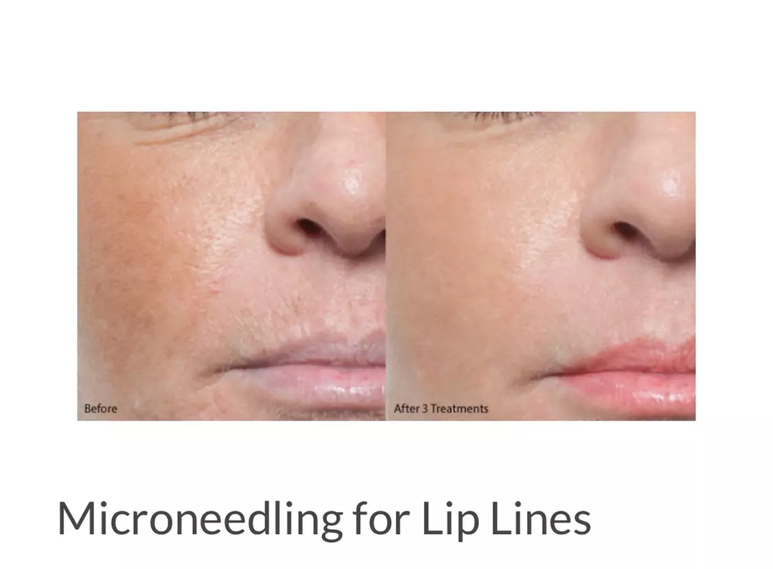 Up to 60% Off on Micro-Needling at Greater Lansing Aesthetic Medicine - Primary Image