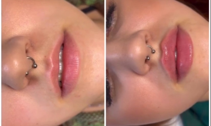 Transform your look with 1ML or 2ML needle-free lip enhancements