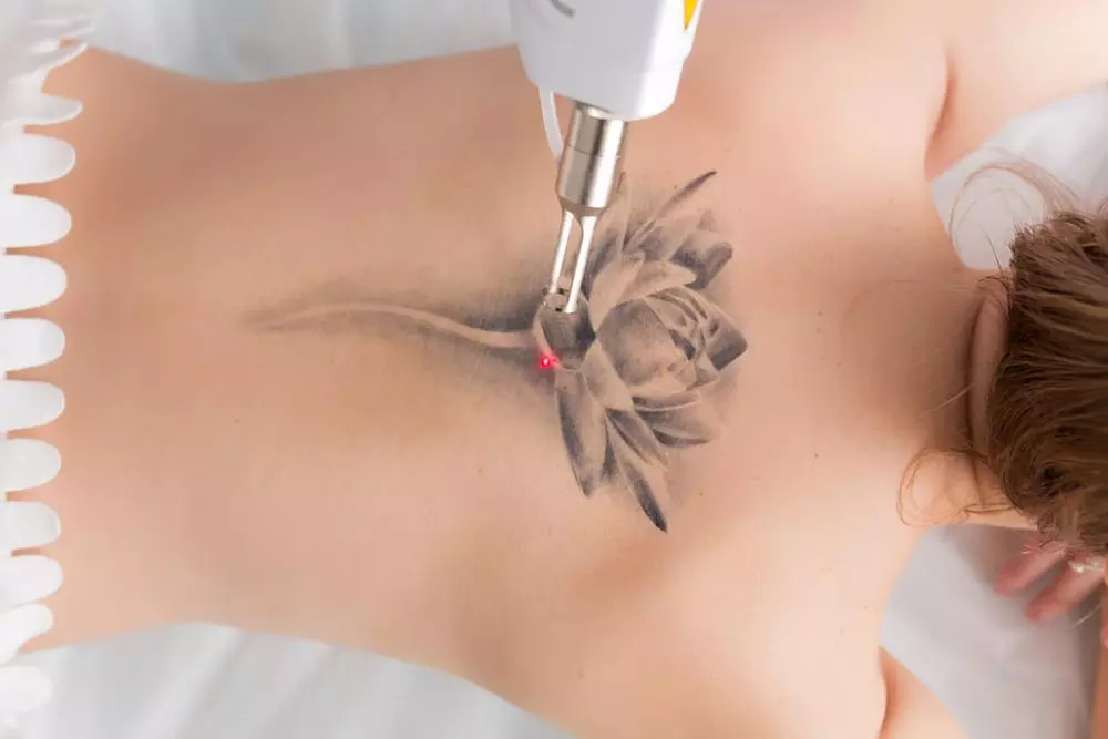 Up to 61% Off on Tattoo Removal at Skin City Lab - Primary Image