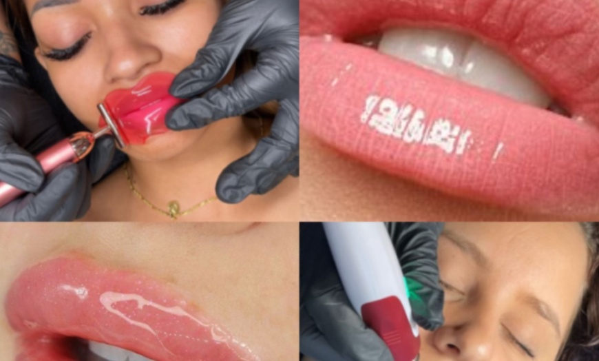 Image 1: Two or Three Hydrogloss Lip Treatments at T Body Contour