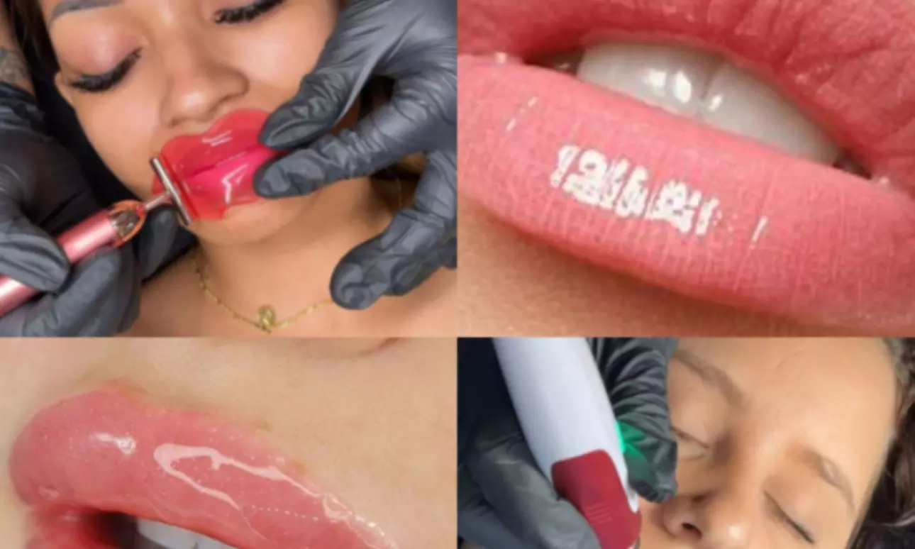 Two or Three Hydrogloss Lip Treatments at T Body Contour
