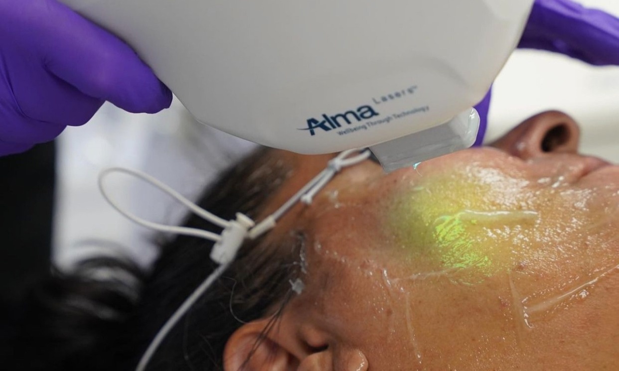 Experience Spot-Free Skin with IPL Spot Removal Treatments