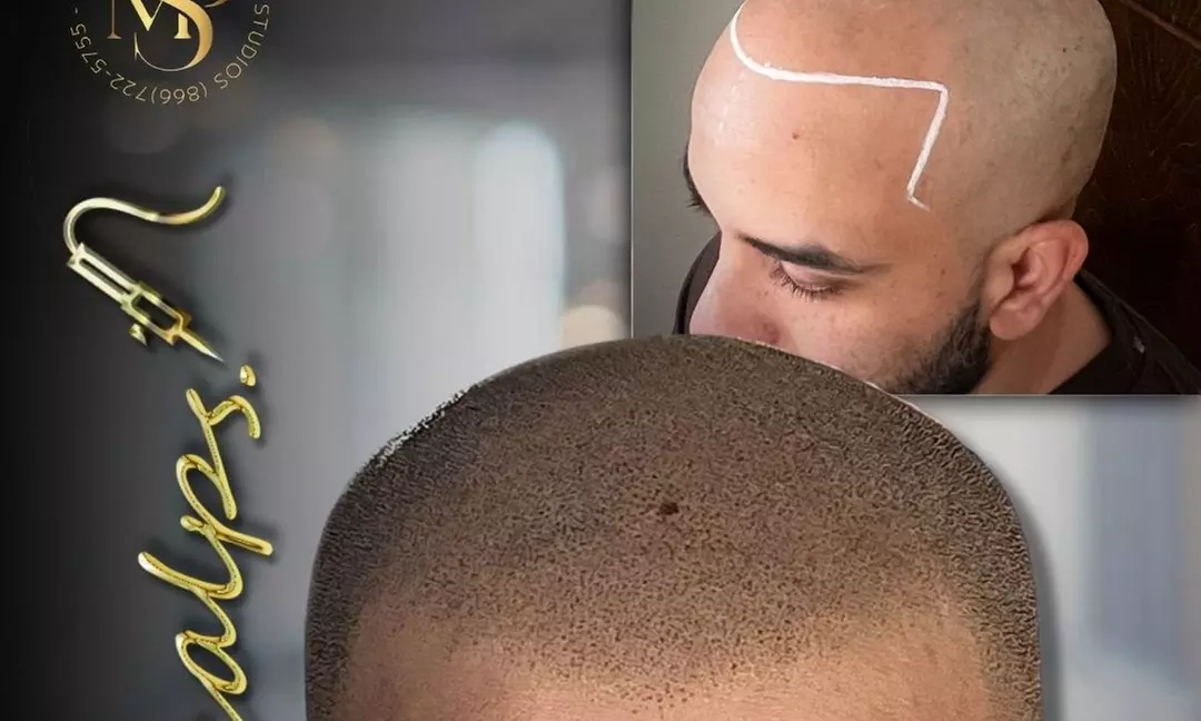 Scalp Micropigmentation Hairline Restoration Solution
