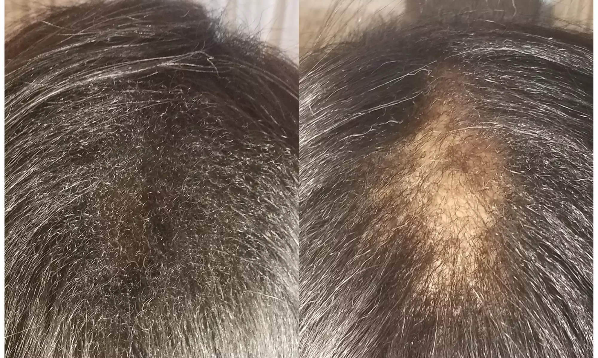 Up to 50% Off on Men and Women's Scalp Micropigmentation