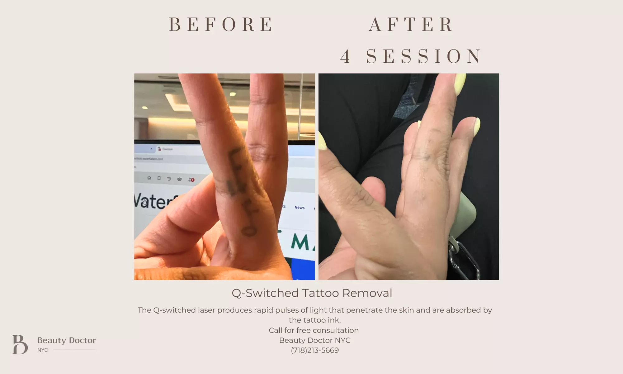 Up to 50% Off on Tattoo Removal at Beauty Doctor NYC - Second Medium