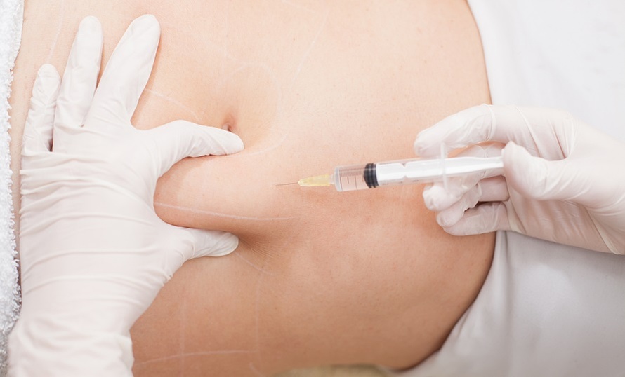 Fat Reduction: Deoxycholic Acid for Small to Large Areas