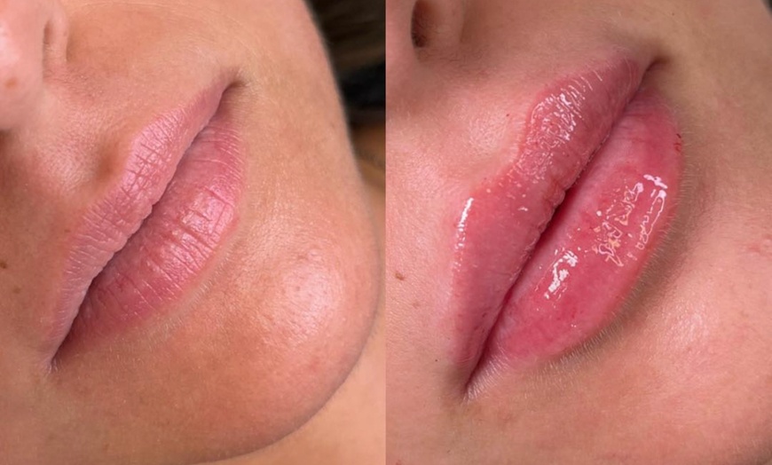 Image 2: Dermal Filler with Consultation at Shani Aesthetics